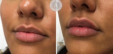 Dermal filler: lip augmentation
