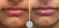 Dermal fillers: lip augmentation